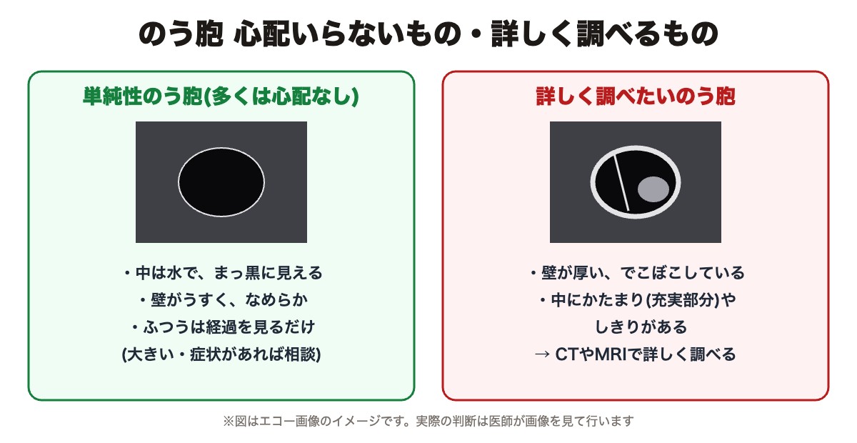 単純性のう胞(心配いらないことが多い)と詳しく調べたいのう胞のちがい(エコー画像のイメージ)