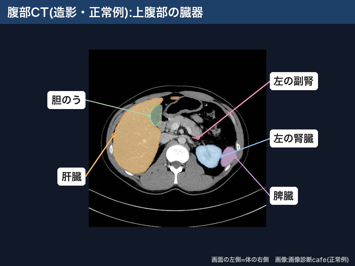 腹部CT(造影・画像診断cafe正常例):肝臓・胆のう・左の副腎・左の腎臓・脾臓
