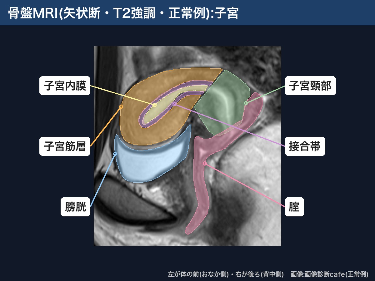 骨盤MRI(矢状断・T2強調・画像診断cafe正常例):子宮内膜・接合帯・子宮筋層・子宮頸部・腟・膀胱